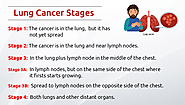 Lung Cancer Stages - Breath Clinic