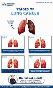Stages of Lung Cancer - Dr. Pankaj Gulati