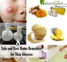 8 Safe and Best Home Remedies for Skin Abscess