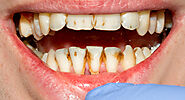 Emergency Dentist | Dental Clinics near Granby, CT 06035