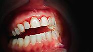Gingivitis: What It Is, Causes, Diagnosis