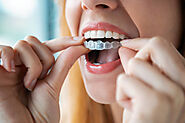 Are Aligners Better Than Braces? – Dental Health Tips