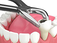 What Happens During a Tooth Extraction: Guide For Simi Valley Patients – Dental Health Tips
