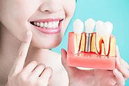 Time to Consider Dental Implants? - The Dental Bond Blog