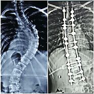 Spinal Deformity Treatment | Spinal Deformity Surgeon in Pune - Dr. Sachin Mahajan