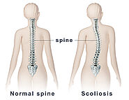 Scoliosis Surgery | Scoliosis Treatment in Pune - Dr. Sachin Mahajan