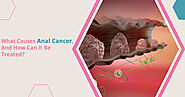 Anal Cancer Causes and Treatment - University Cancer Centers