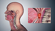 Cause & Symptoms Of Oropharyngeal Cancer
