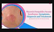 Mycosis Fungoides Sezary Syndrome: Symptoms, Diagnosis and Treatment