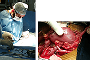 Best Kidney Transplant Surgeon in Indore, Kidney Transplant in Indore | Dr Yusuf Saifee