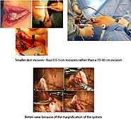 Laparoscopic Kidney Surgery in Indore, Laparoscopic Kidney Surgeons in Indore | | Dr Yusuf Saifee