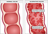 Ulcerative Colitis - Homeopathic Treatment - by Victor Tsan, MD