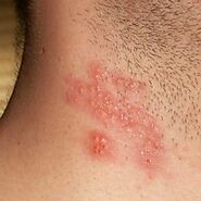 Homeopathic Treatment for Shingles - Philadelphia Homeopathic Clinic