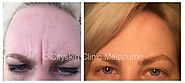Frown / brow line treatment | Cityskin Melbourne & Sydney | From $4.50 per unit