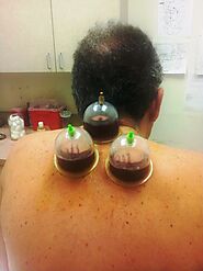 Hijama aka wet cupping - the treatment of choice delivered by Dr. Tsan