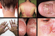 Natural and Home Remedies for Effective Management of Psoriasis Symptoms