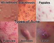 Website at https://philaacupuncture.com/natural-treatment-for-acne/