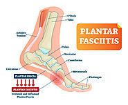 Treatment for plantar fasciitis - Philadelphia Holistic Clinic