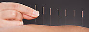 acupuncture treatment by Dr. Tsan at Philadelphia Acupuncture Clinic