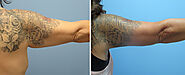 Upper Arm Lift / Brachioplasty Body Contouring | Cosmetic and Plastic Surgery | Vancouver Langley BC | Dr. Ashley Tre...