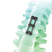 What is spine implant?