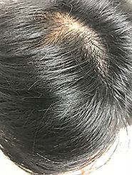 Hair Loss Treatment Adelaide SA | Scalp Disorder Treatment Findon SA