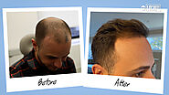Hair Loss Centre Adelaide - Hair Regrowth Treatment South Australia