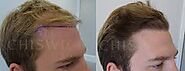 Hair Loss Centre Adelaide - Hair Regrowth Treatment South Australia