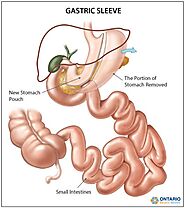 The Gastric Sleeve - Sustained Weight Loss is Possible