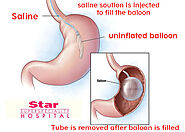 Weight Loss With Gastric Balloon - Toronto Cosmetic Surgery Clinic