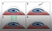 Photorefractive Keratectomy (PRK) - Halifax Eye Institute - Dr. Hesham Lakosha