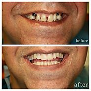 ایمپلنت دندان (کاشت دندان ) چیست؟ مزایا, عوارض,انواع,قیمت,هزینه - کلینیک تخصصی دندان پزشکی دکتر آرش راد