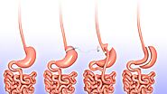 The incidence of iron deficiency anemia post-Roux-en-Y gastric bypass and sleeve gastrectomy: a systematic review - P...