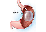 Intragastric balloon | Gastric Balloon | Weight Loss Surgery In Pune