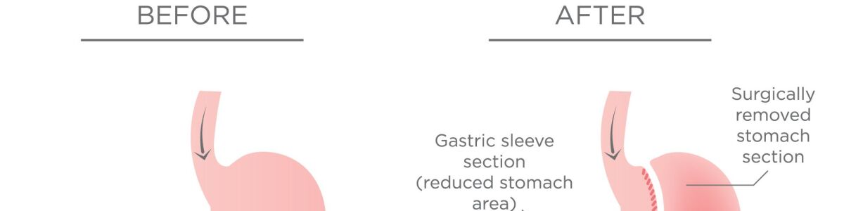 Headline for Gastric Sleeve Surgery in Burnaby