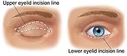 Blepharoplasty - Halifax Eye Institute - Dr. Hesham Lakosha
