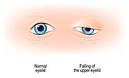 Eyelid Surgery: Before Your Surgery