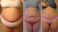 Body Contouring After Weight Loss | The Plastic Surgery Clinic
