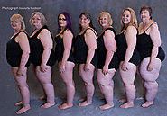 Stages of Lipedema