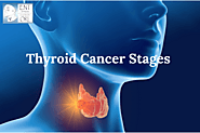 Thyroid Cancer Stages | ENT Specialty Group