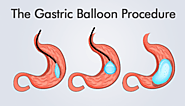 Gastric Balloon Surgery in Ontario | A Listly List