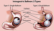 Gastric Balloon - Obesity, Bariatric Surgery in Turkey