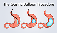 What You Need to Know About Gastric Balloon Procedure