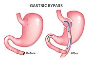 Gastric bypass surgery: MedlinePlus Medical Encyclopedia