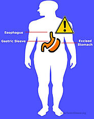 Sleeve Gastrectomy Risks & Complications | Gastric Sleeve Surgery