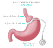 Safe Bariatric Surgery in Tijuana, Mexico - Dr. Lopez Corvala