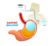 Gastric Balloon for Weight Loss - The Clinic At Beverly Hills
