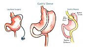 Gastric Sleeve Surgery Lubbock | Laparoscopic Sleeve Gastrectomy West Texas