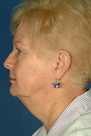 Neck Lift Surgery - Costs, Results, Risks, Recovery