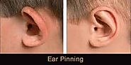 Otoplasty Brampton | Ear Surgery